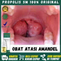 Detail Kanker Tonsil Gambar Nomer 49