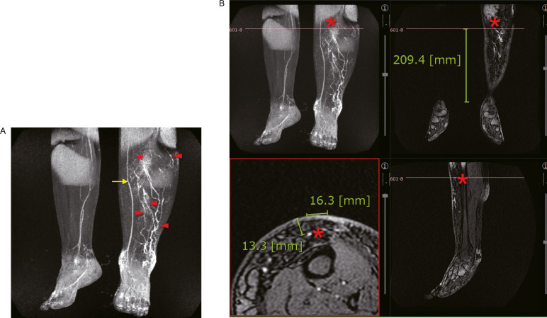 Detail Arteri Tibialis Posterior Nomer 37