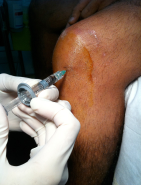 Detail Asam Hyaluronic Injeksi Nomer 19