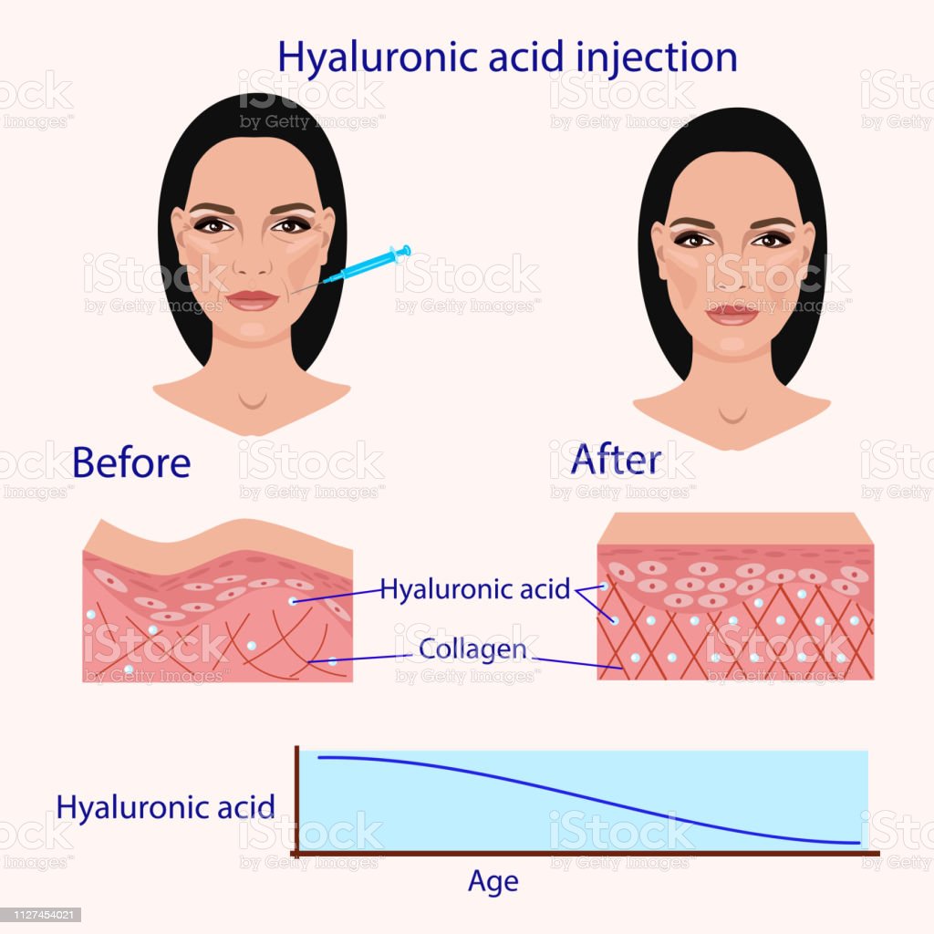 Detail Asam Hyaluronic Injeksi Nomer 47