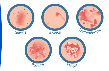 Psoriasis Bilder - KibrisPDR