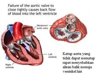 Detail Katup Jantung Buatan Nomer 36