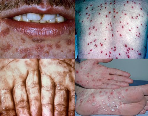 Detail Gambar Penyakit Sifilis Nomer 17