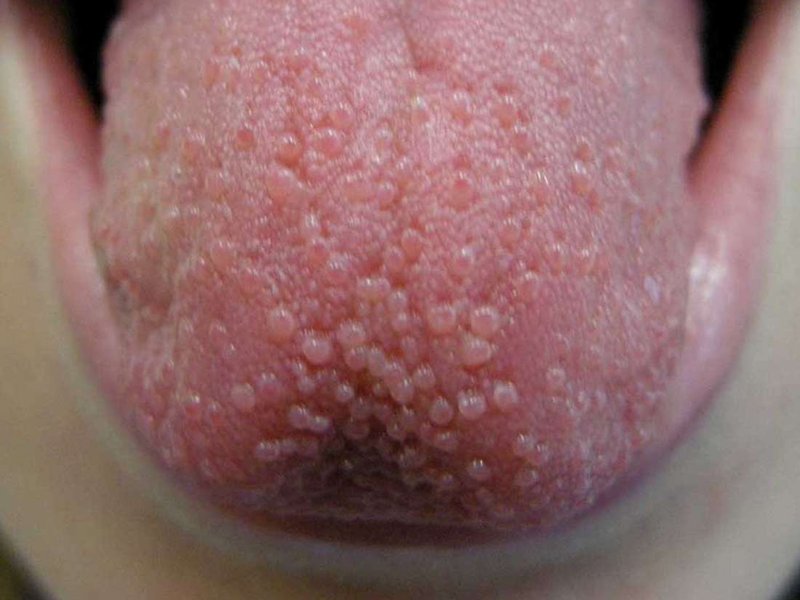 Detail Gambar Penyakit Sifilis Nomer 18