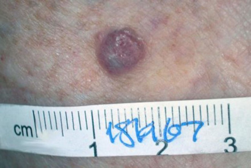 Detail Gambar Kanker Kulit Melanoma Nomer 47