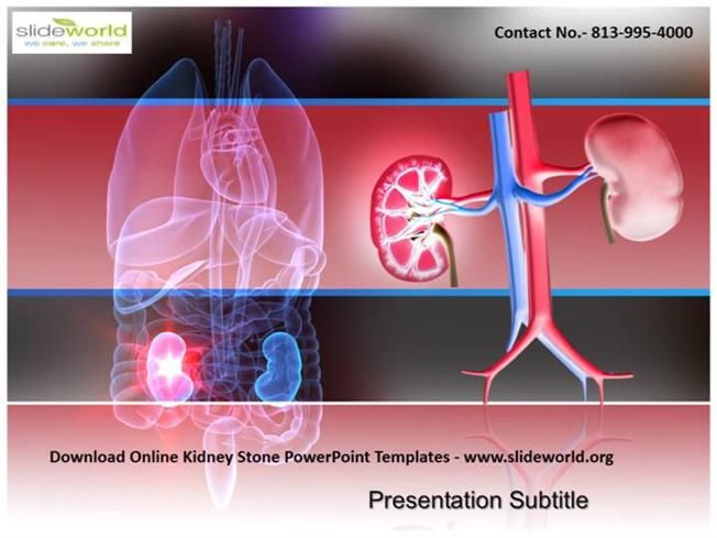 Detail Kidney Stone Ppt Nomer 14
