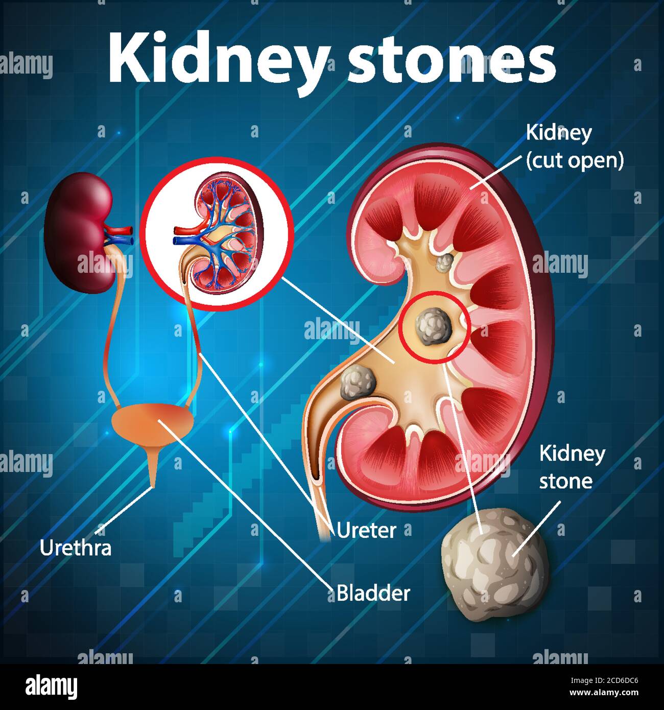 Detail Kidney Stone Ppt Nomer 17