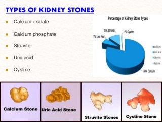Detail Kidney Stone Ppt Nomer 3