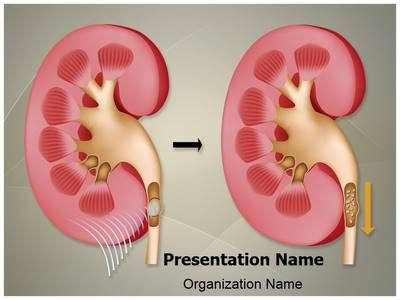 Detail Kidney Stone Ppt Nomer 28