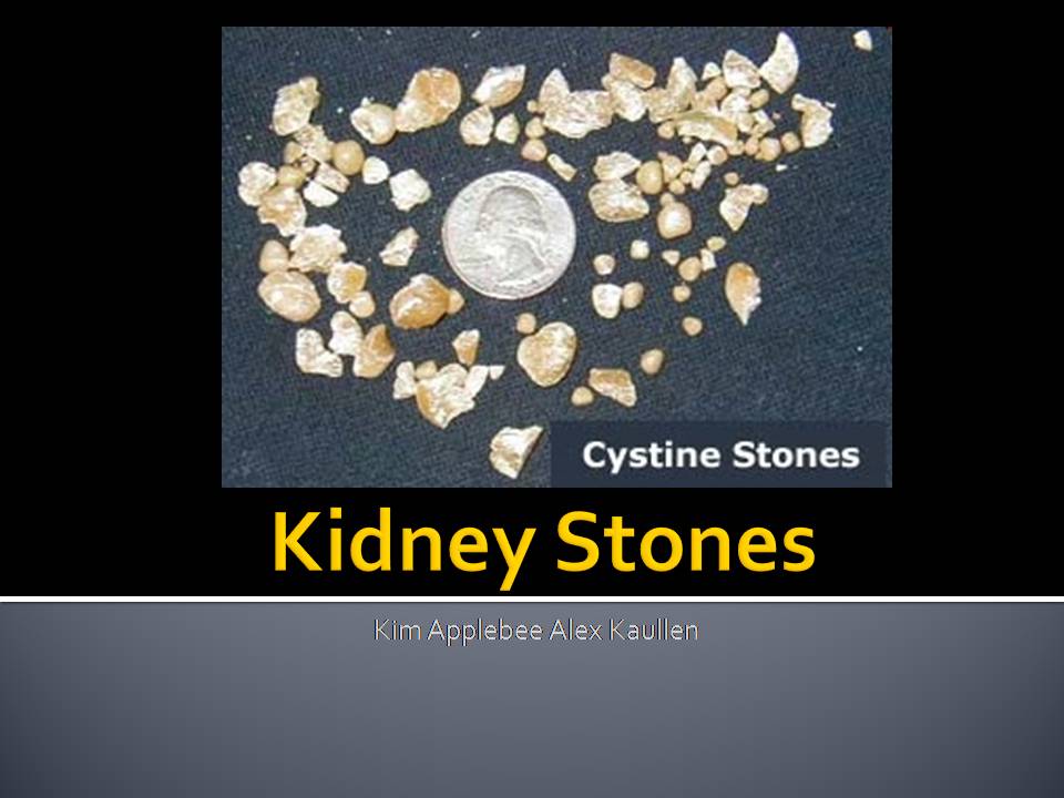 Detail Kidney Stone Ppt Nomer 5