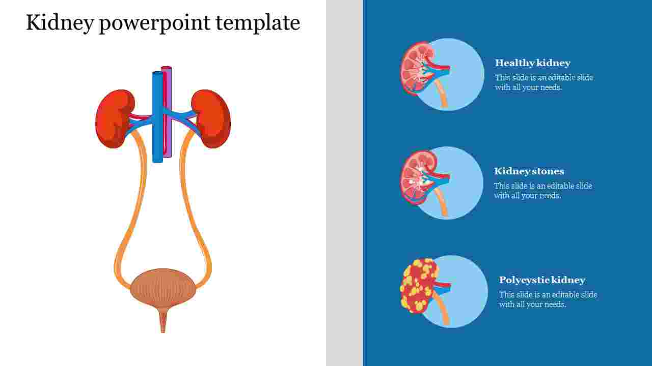 Detail Kidney Stone Ppt Nomer 38