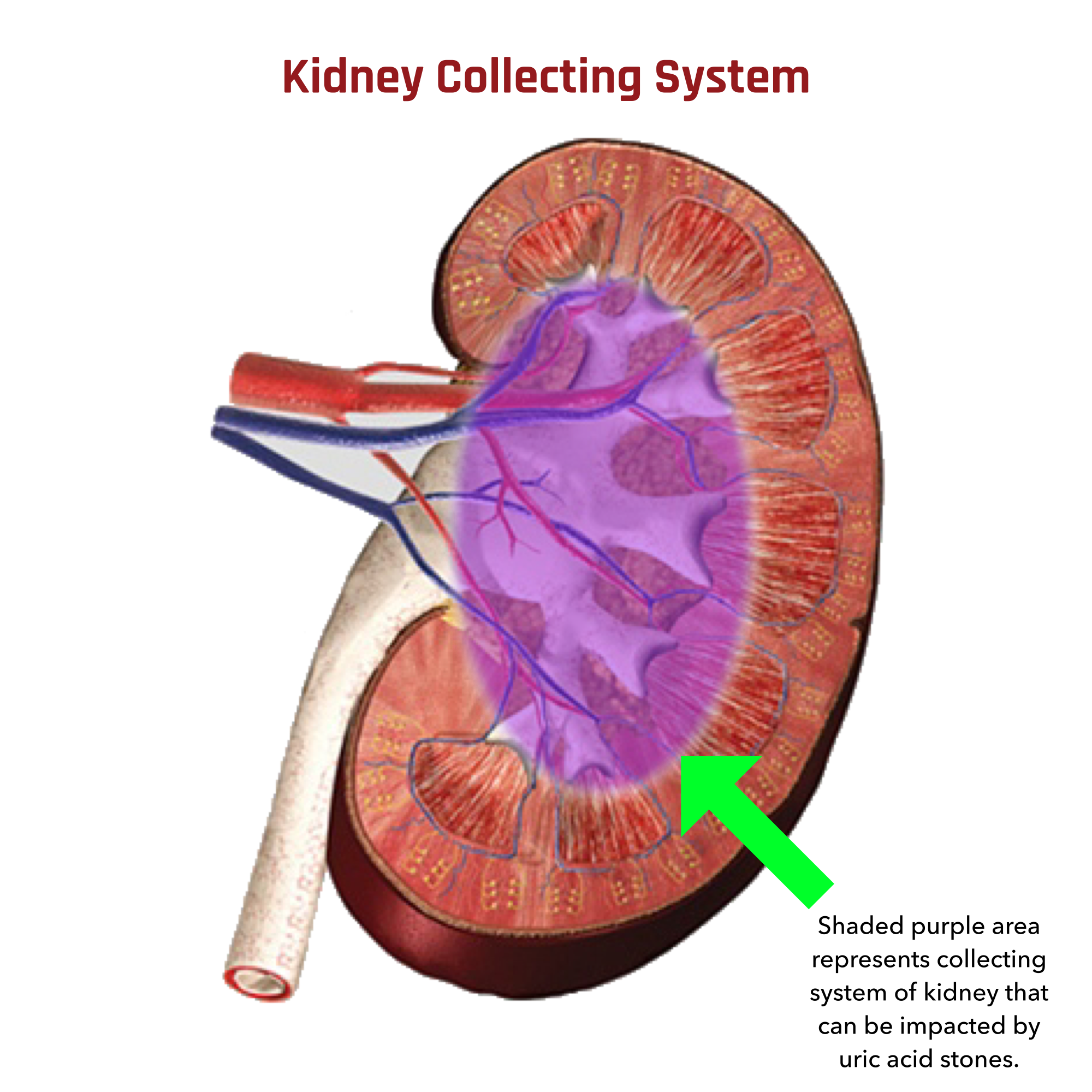 Detail Kidney Stone Ppt Nomer 53