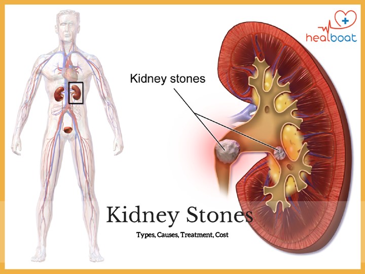 Detail Kidney Stone Ppt Nomer 7