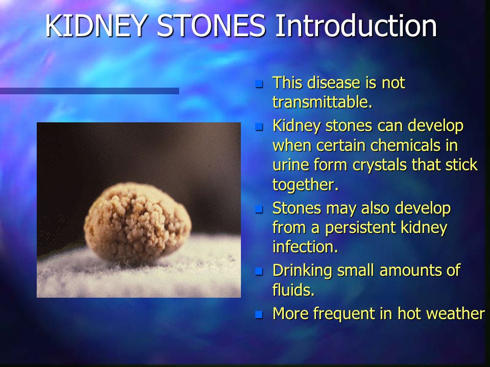 Detail Kidney Stone Ppt Nomer 8
