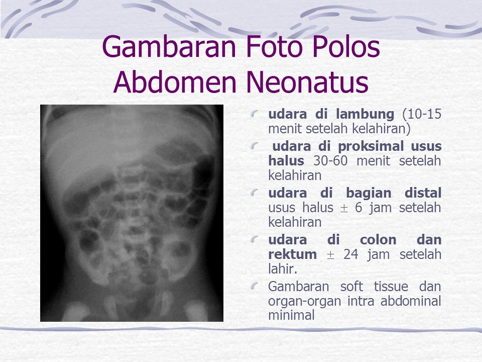 Detail Kriteria Gambar Abdomen Later Nomer 10