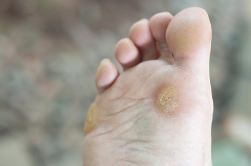 Detail Kutil Plantar Di Telapak Kaki Nomer 35