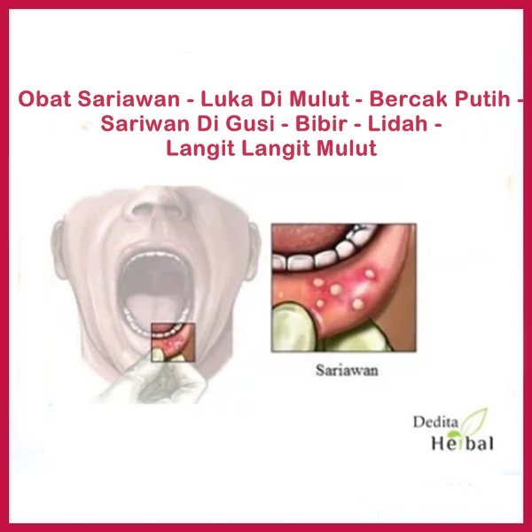 Detail Langit Langit Mulut Putih Nomer 25