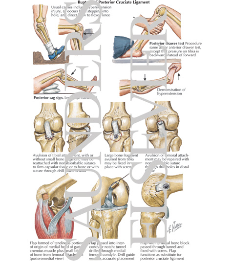 Detail Ligamentum Cruciatum Anterius Nomer 27