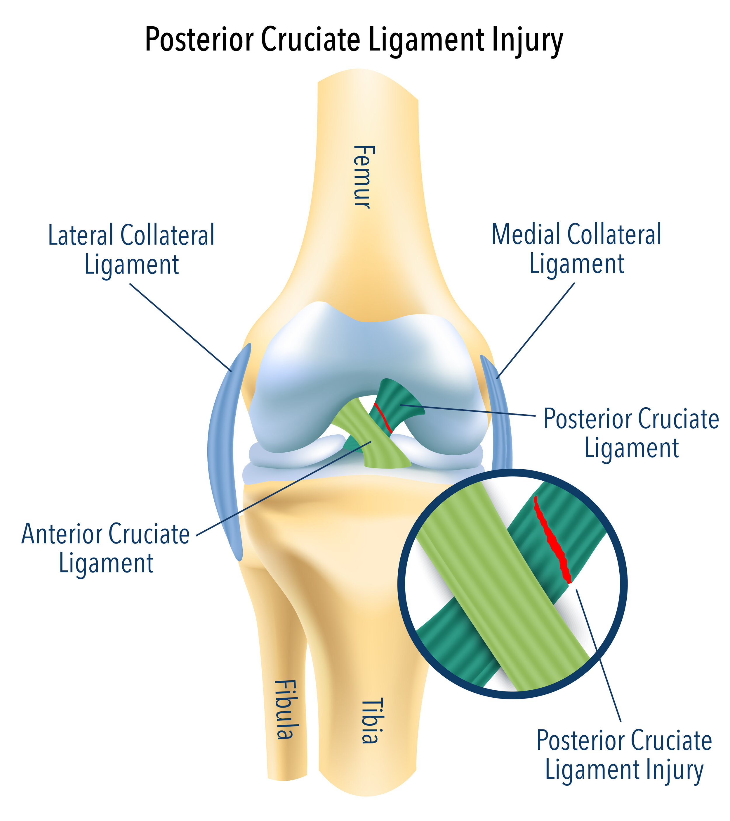 Detail Ligamentum Cruciatum Posterior Nomer 17