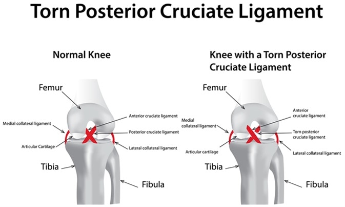 Detail Ligamentum Cruciatum Posterior Nomer 18