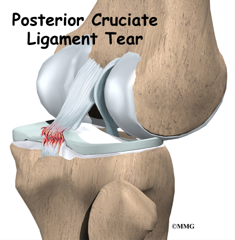 Detail Ligamentum Cruciatum Posterior Nomer 31