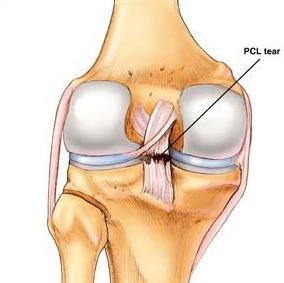 Detail Ligamentum Cruciatum Posterior Nomer 37