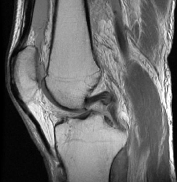 Detail Ligamentum Cruciatum Posterior Nomer 41