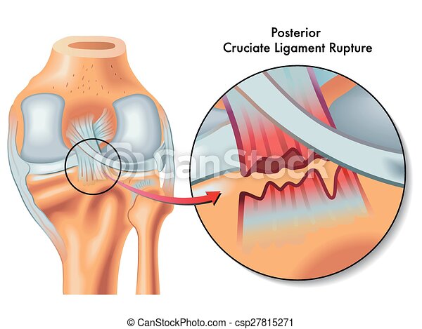 Detail Ligamentum Cruciatum Posterior Nomer 52