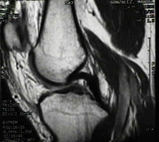 Detail Ligamentum Cruciatum Posterior Nomer 53