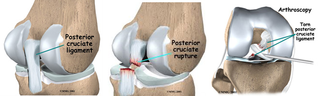 Detail Ligamentum Cruciatum Posterior Nomer 55