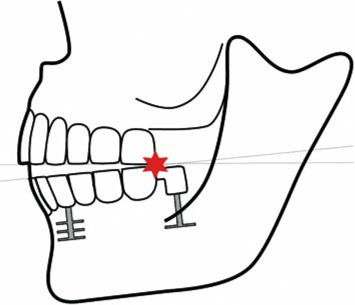 Detail Musculus Pterygoideus Medialis Nomer 3