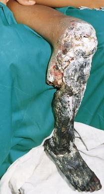 Detail New Russian Drug Krokodil Wiki Nomer 59