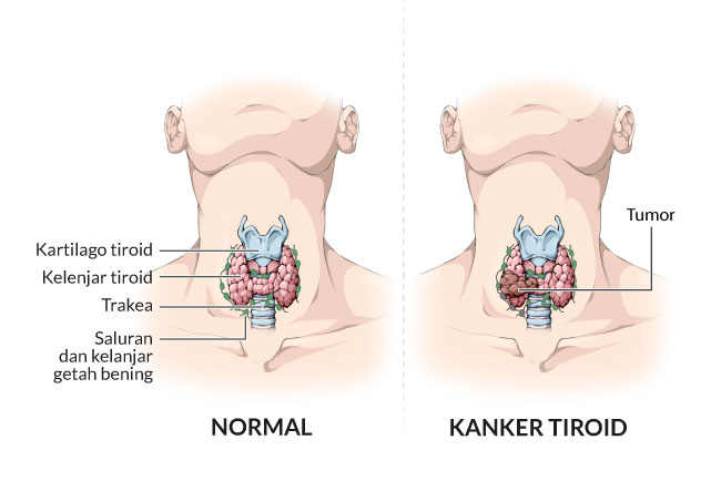 Detail Obat Tradisional Tiroid Rumah Nomer 27