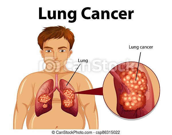 Detail Lung Cancer Clipart Nomer 25