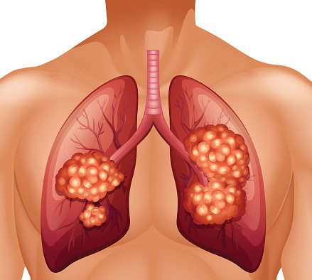 Detail Lung Cancer Clipart Nomer 26