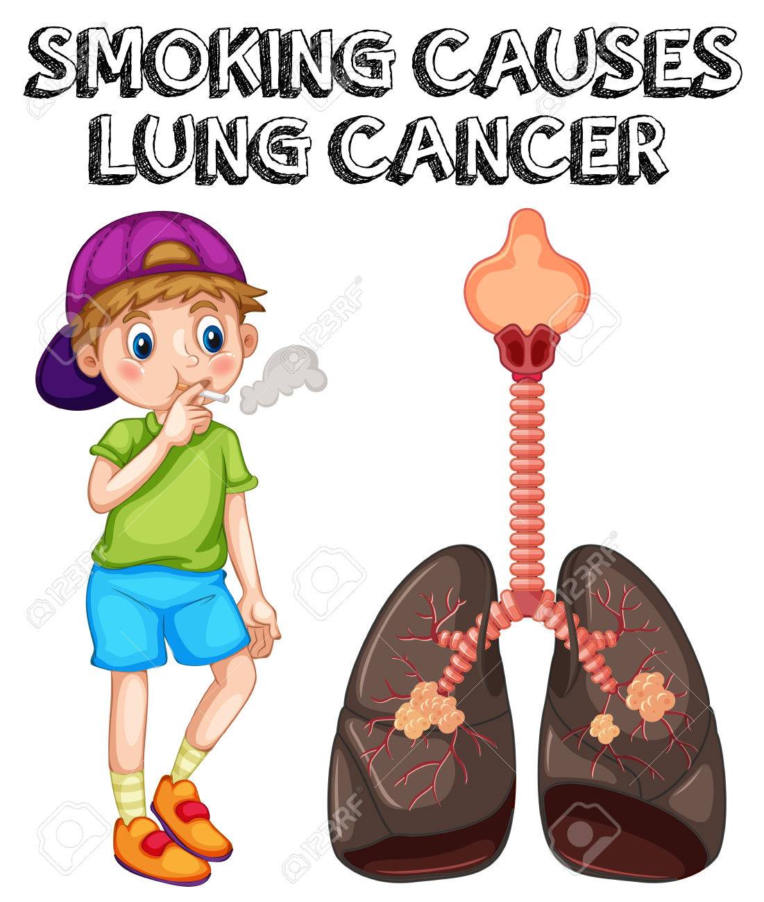 Detail Lung Cancer Clipart Nomer 37