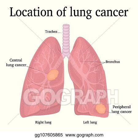 Detail Lung Cancer Clipart Nomer 56