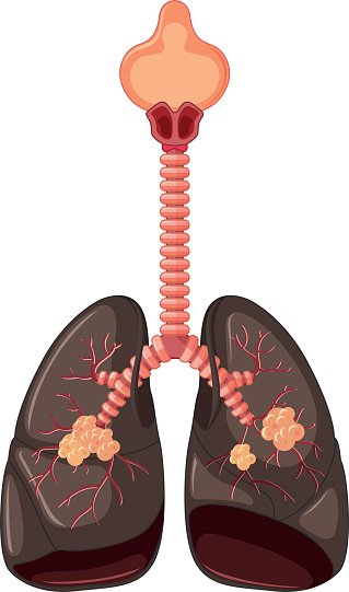Detail Lung Cancer Clipart Nomer 7
