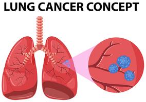 Detail Lung Cancer Clipart Nomer 9