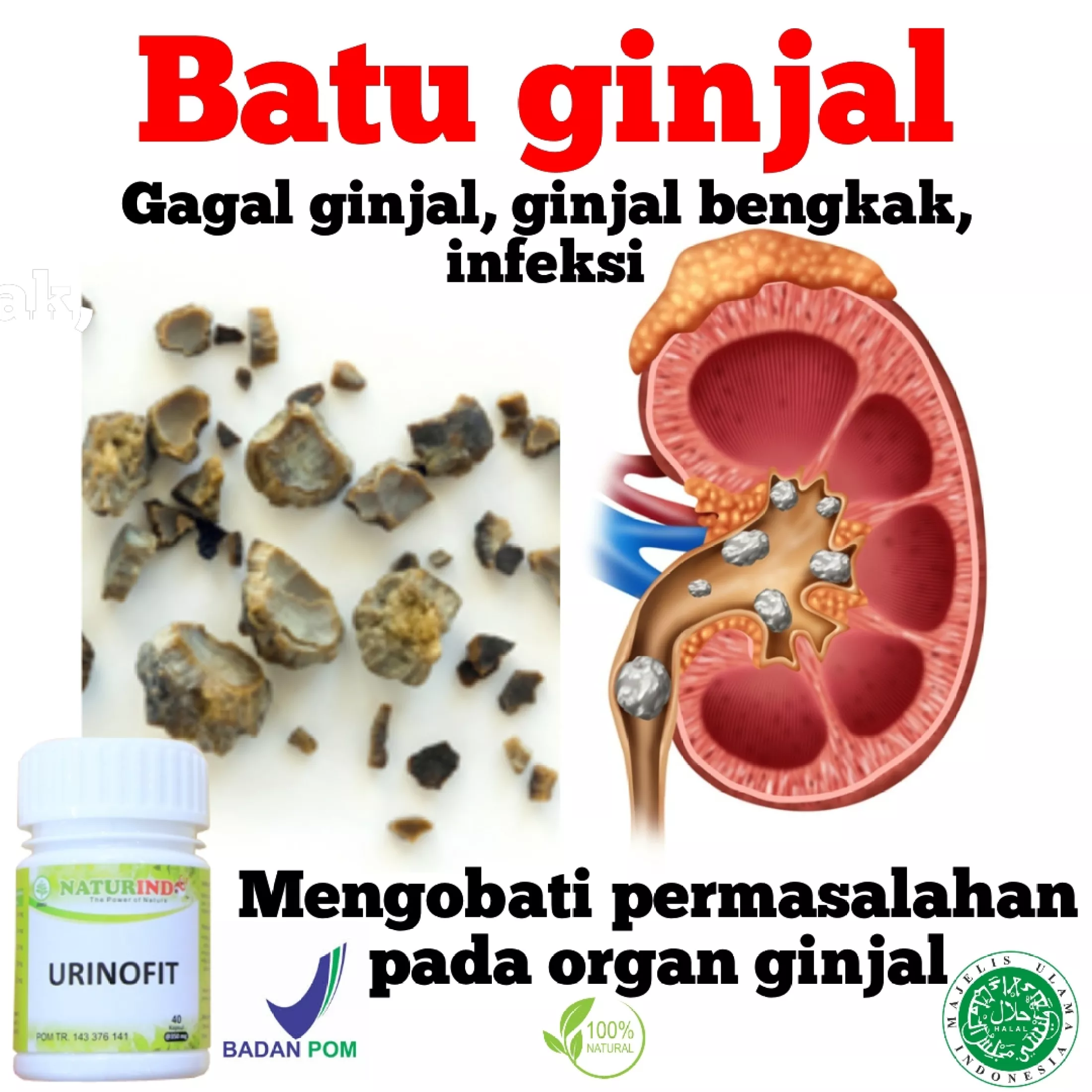 Detail Penghancur Batu Ginjal Paling Ampuh Nomer 3