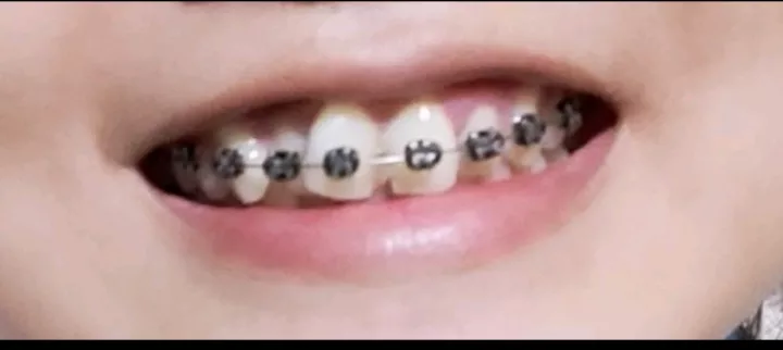 Detail Macam Macam Behel Dan Gambarnya Nomer 35