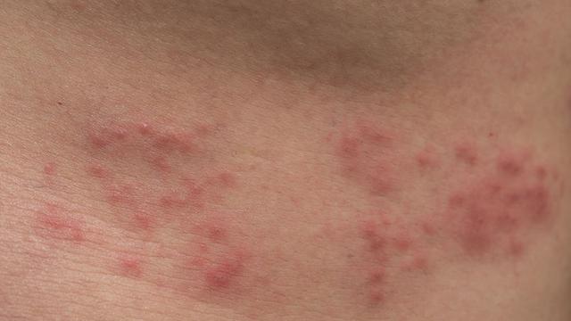Macam Macam Herpes Dan Gambarnya 48 Koleksi Gambar Macam Macam Herpes Dan Gambarnya 48 Koleksi Gambar