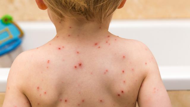 Macam Macam Herpes Dan Gambarnya 48 Koleksi Gambar Macam Macam Herpes Dan Gambarnya 48 Koleksi Gambar