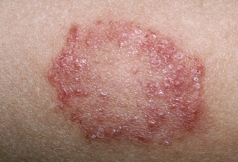 Detail Macam Macam Herpes Dan Gambarnya Koleksi Nomer 13 Detail Macam Macam Herpes Dan Gambarnya Koleksi Nomer 13