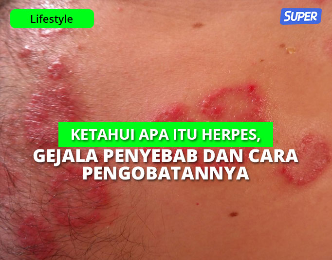Detail Macam Macam Herpes Dan Gambarnya Koleksi Nomer 28 Detail Macam Macam Herpes Dan Gambarnya Koleksi Nomer 28