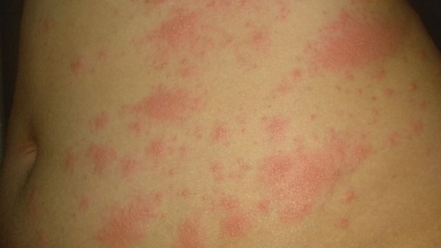 Detail Penyakit Kulit Hives Dan Gambarnya Nomer 26
