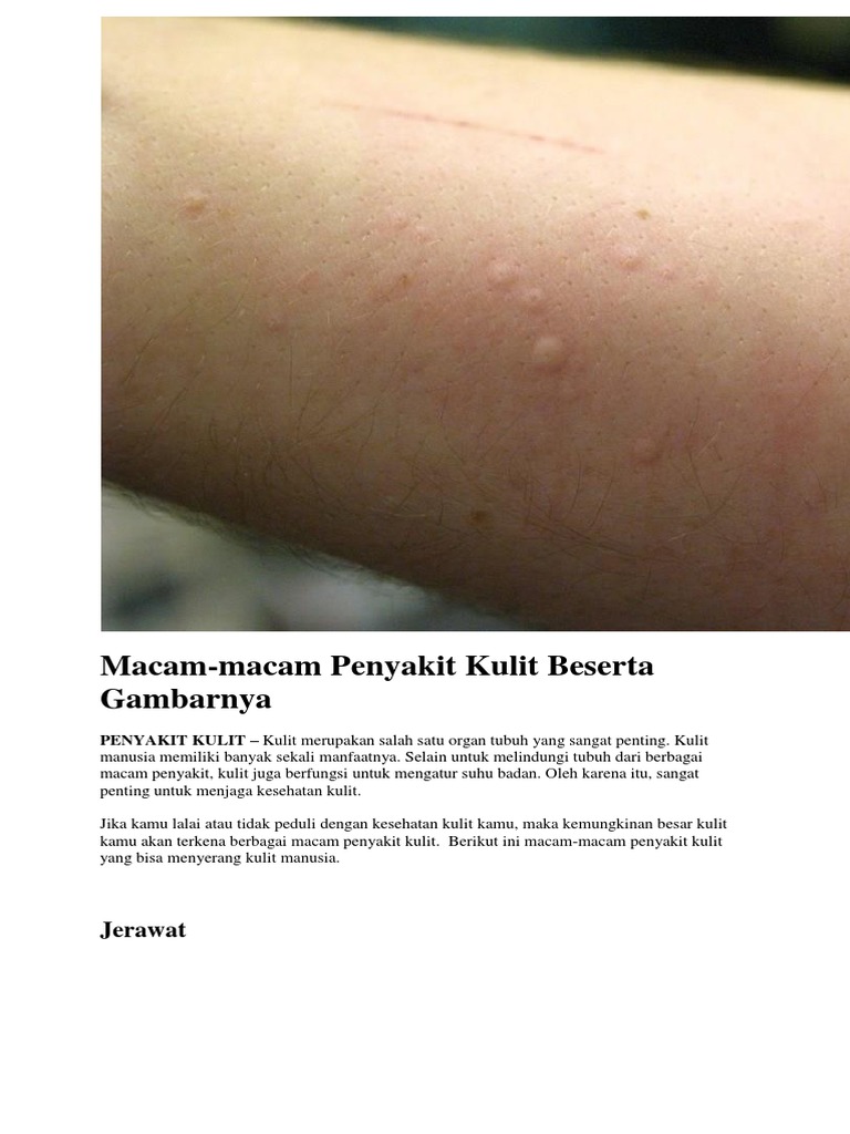 Detail Penyakit Kulit Hives Dan Gambarnya Nomer 28