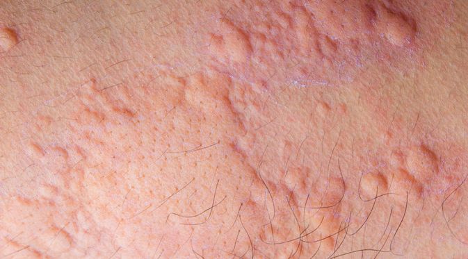 Detail Penyakit Kulit Hives Dan Gambarnya Nomer 8