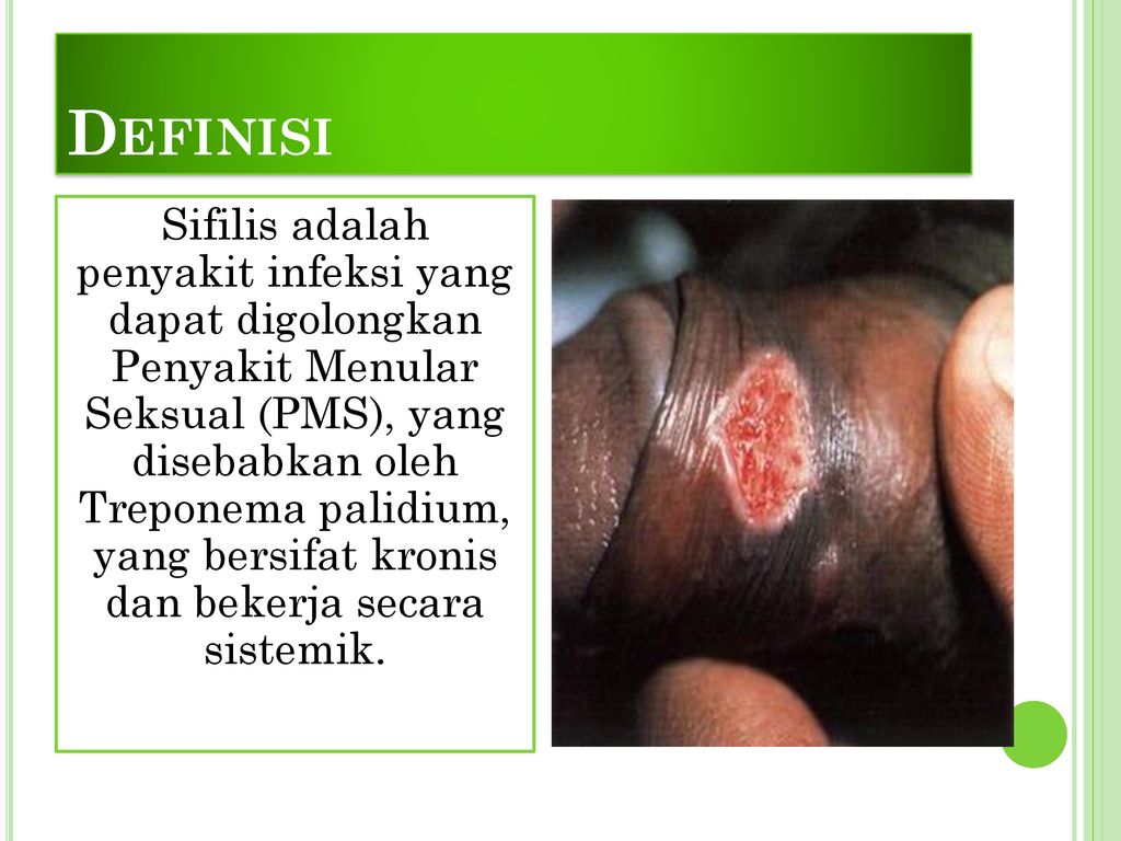 Detail Penyakit Sipilis Gambar Nomer 55