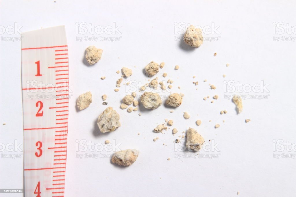 Detail Makalah Batu Ginjal Nomer 33